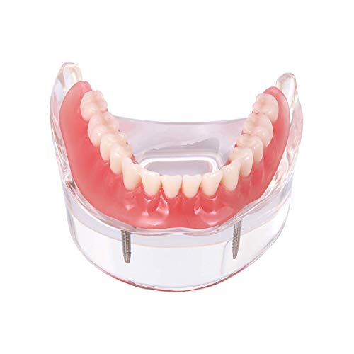 Модел на заби за заби на Seefdent, реставрација на претерано оптоварување со 2 импланти пониско демо, стандарден патолошки модел на настава за