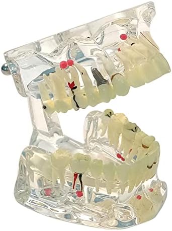 Модел на заби на заби KH66ZKY, модел на демонстрација на сеопфатна патологија, за едукација, комуникација на пациенти, учење