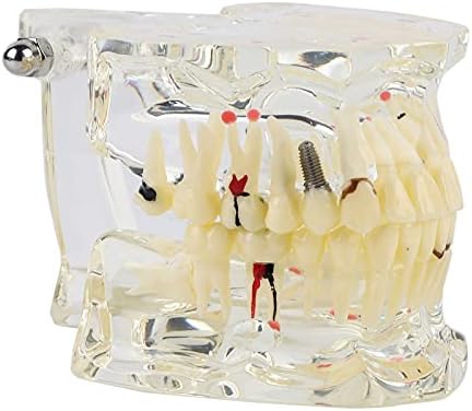 Vifemify Реставрација модел на заби, Нова студија за заби за настава Стандарден модел на заби демонстрација на болести едукативни.