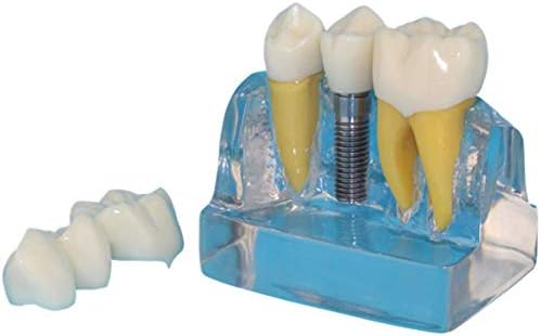 Модел на забите за импланти, човечки модел на орален заб, транспарентен модел на заби