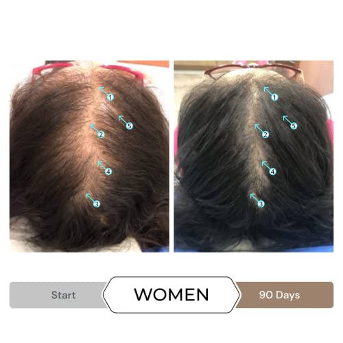 Спектрално.Днц-Н Остави Во Серумот За Поддршка На Растот На Косата Од Лабораториите На Дс-Миноксидил Алтернатива За Мажи И Жени, Доживејте